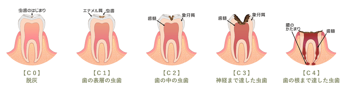 虫歯の進行