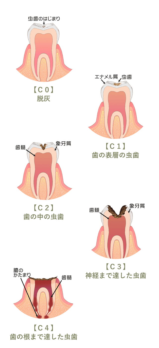 虫歯の進行