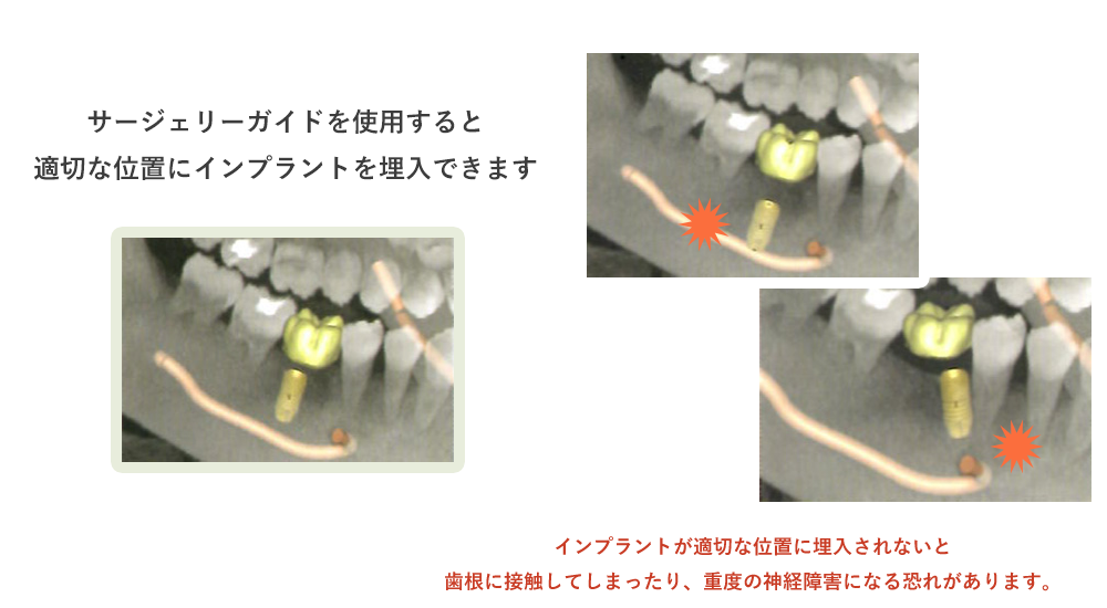 サージェリーガイドを使用すると
