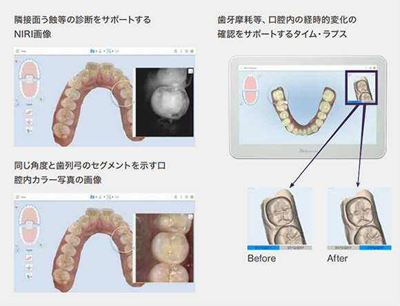虫歯や歯石がわかる