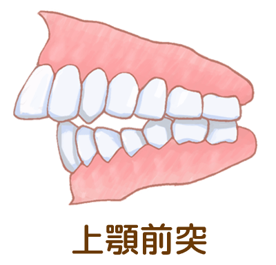 上顎前突