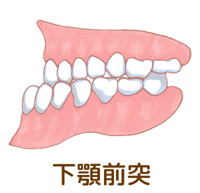 下顎前突