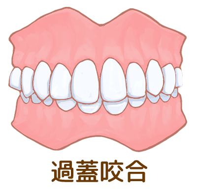 過蓋咬合
