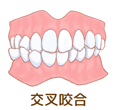交叉咬合