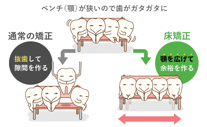 拡大床矯正