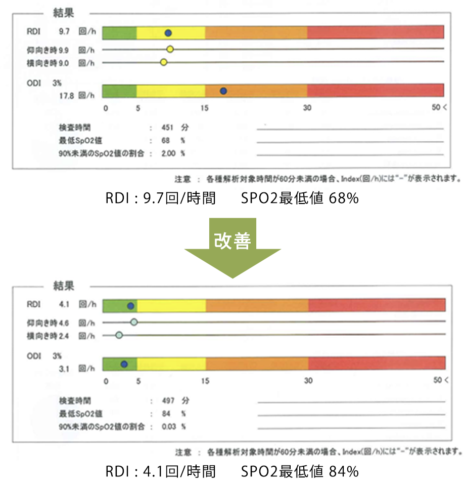 スリープスプリント装置前後で睡眠時無呼吸簡易検査結果の比較