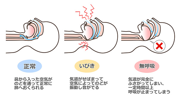 睡眠時無呼吸症候群