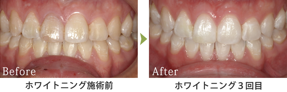 オフィスホワイトニング症例