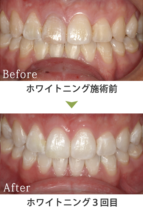 オフィスホワイトニング症例