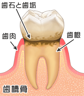 軽度の歯周病