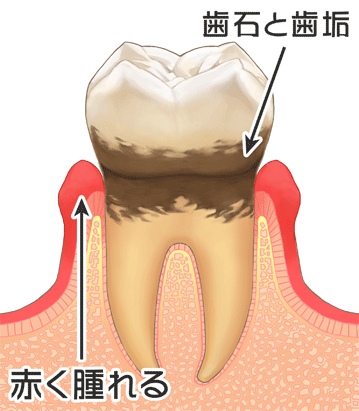 中等度の歯周病