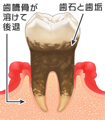 重度の歯周病