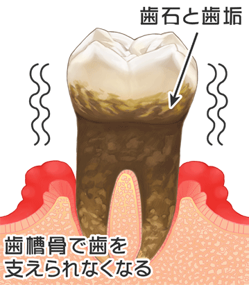 さらに重度の歯周病